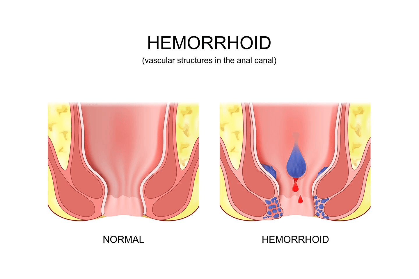 Prominent Symptoms to Identify Piles Early